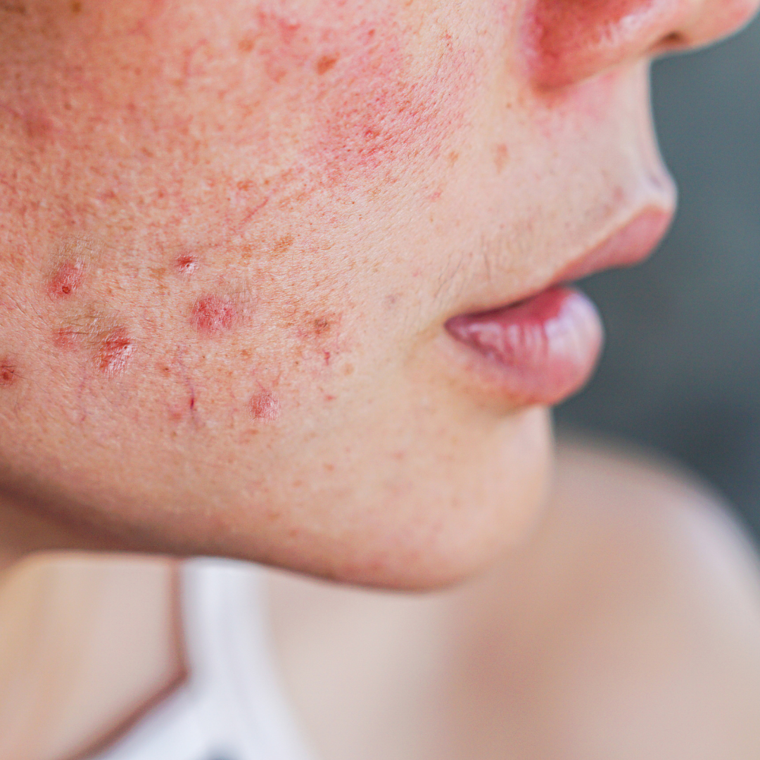 How to get rid of acne scars?