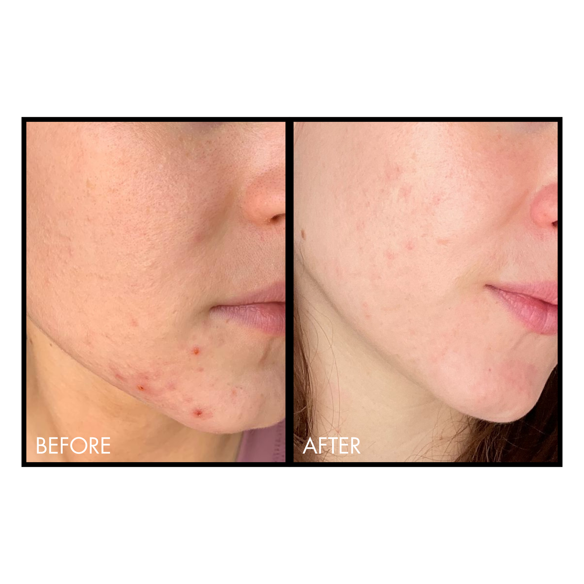 Before and after comparison of a person's face with acne treatment.