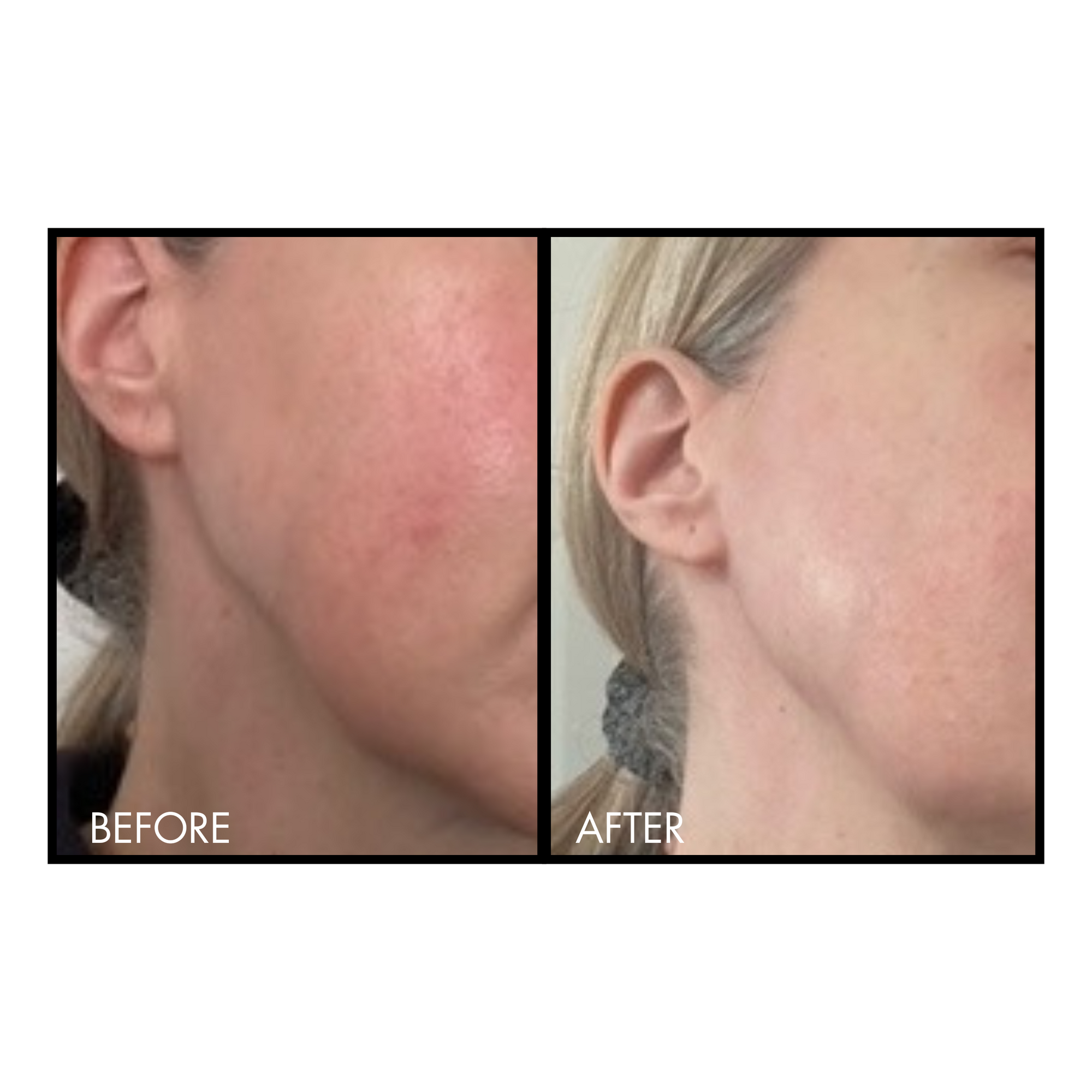 Before and after comparison of a person's neck skin with visible improvement.